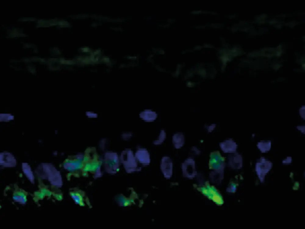 

Immunofluorescence staining of GP100, a melanocyte-specific antigen (green fluorescence). The cell nuclei are stained with DAPI (blue fluorescence).