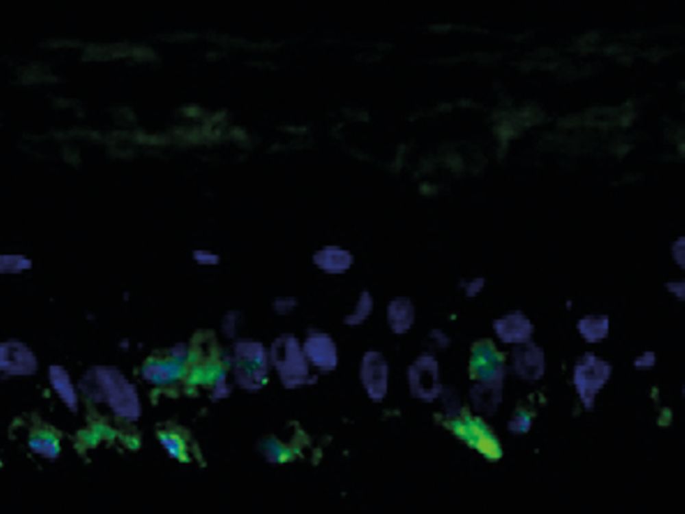 Fig. 2: Immunofluorescence staining of GP100, a melanocyte-specific antigen (green fluorescence). The cell nuclei are stained with DAPI (blue fluorescence).