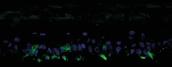 

Immunofluorescence staining of GP100, a melanocyte-specific antigen (green fluorescence). The cell nuclei are stained with DAPI (blue fluorescence).